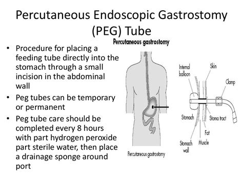 pegogram|Percutaneous endoscopic gastrostomy